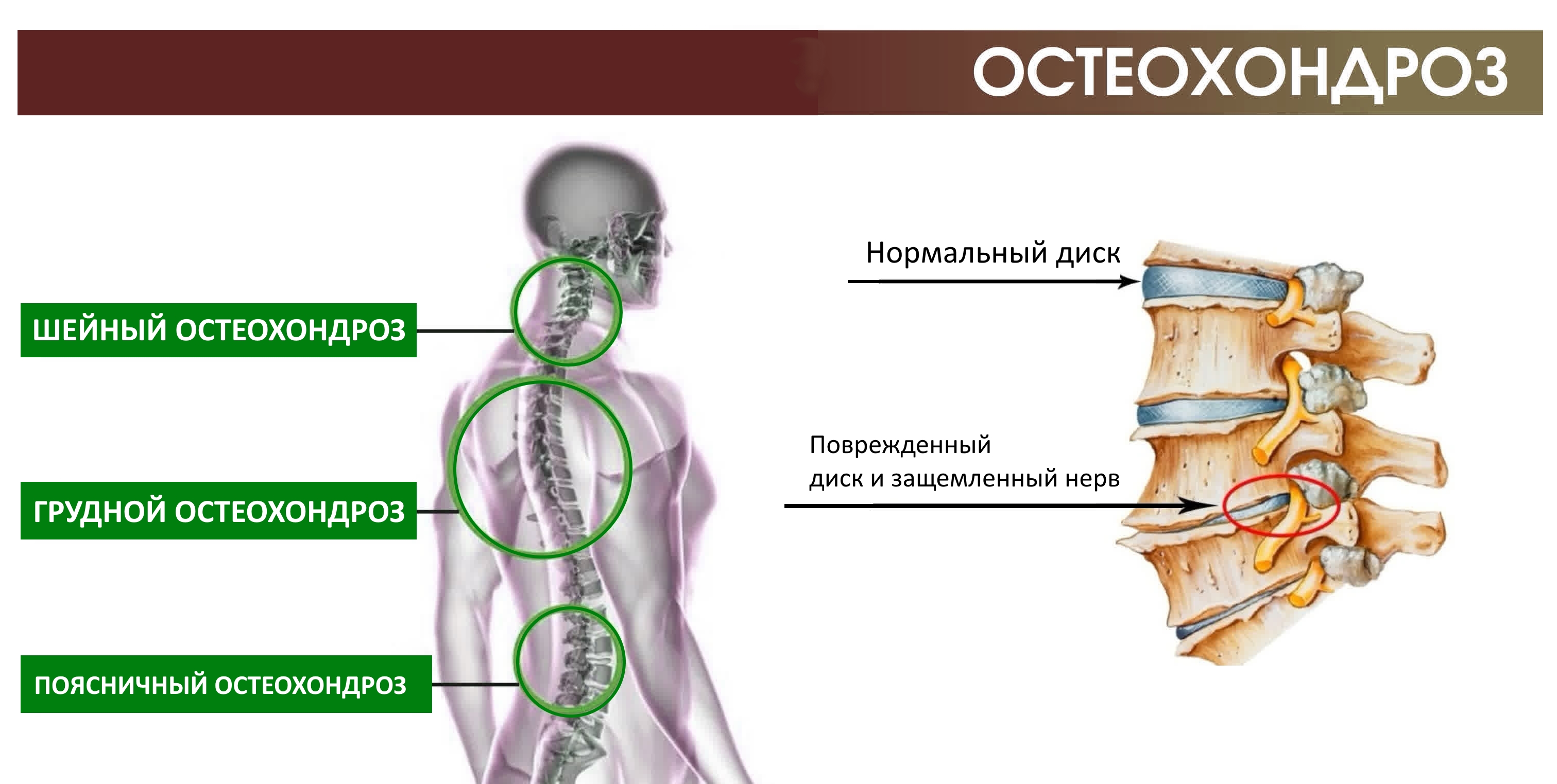 Лечение боли позвоночника в клинике СПб – медицинский центр заболеваний  спины, врач невролог | Цена